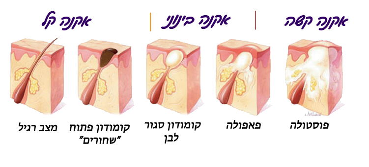 אילוסטרציה הממחישה את סוגי אקנה שונים: קומדון פתוח (ראש שחור), קומדון סגור (ראש לבן), פפולה ופוסטולה.