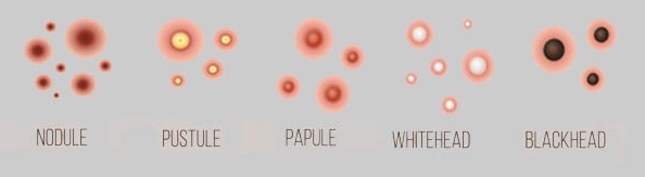 תמונת סוגי פצעי אקנה, כולל נודולים, פוסטולות, פאפולות, פצעונים לבנים ושחורים, עם המאפיינים שלהם.