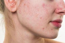 תמונה של פנים של אישה עם פצעי אקנה וכתמים אדומים על העור.