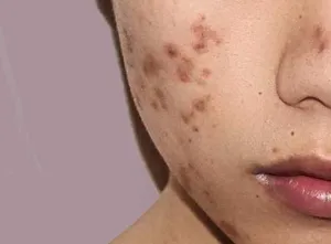 Close-up image of a person's cheek showing dark, uneven patches of skin caused by post-inflammatory hyperpigmentation after acne.