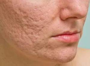 תמונה מקרוב של עור עם צלקות אטרופיות בעקבות אקנה, המראה שקעי עור וסימני פגיעה.