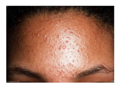תמונה המראה פצעונים זעירים על מצח אדם, עם גוון אדמומי ומעט בולט על פני העור.