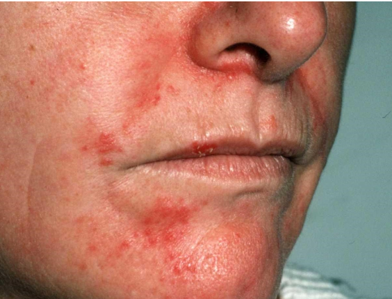 תמונה של עור עם אדמומיות ופצעים סביב הפה, המצביע על סבוריאה דרמטיטיס.