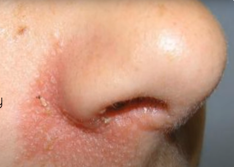 תמונה של פנים עם אדמומיות וסימנים בעור סביב האף, עשויה להעיד על מצב סבוריאה דרמטיטיס.