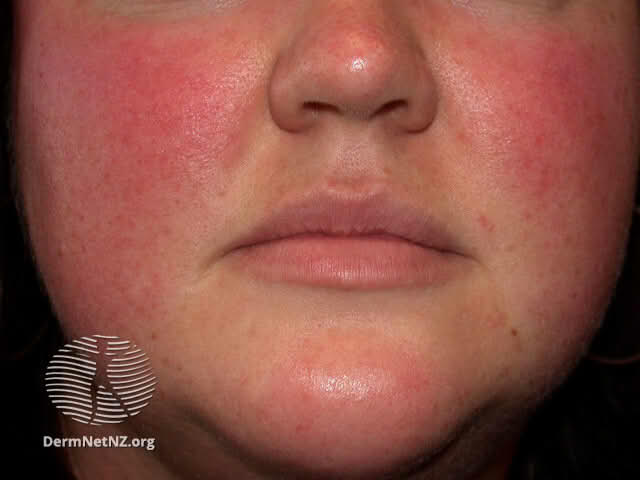 Close-up of a person's face showing significant redness and irritation, indicative of rosacea, with symptoms evident on the cheeks and nose.