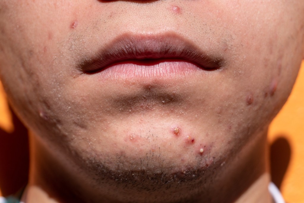 Close-up of a person's chin and lower face showing acne lesions and scarring.