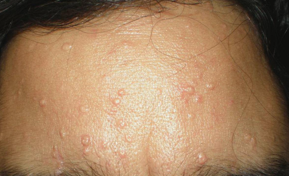 תמונה של מצח עם פצעונים אדומים זעירים, שנראים כגבשושיות, על פני עור חלק.