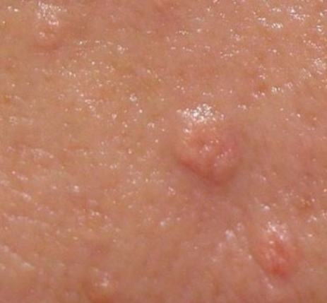 תמונה של עור עם גבשושיות קטנות, המתארות תופעה של פצעונים, דומים לפצעוני אקנה. המראה כולל אדמומיות קלה ואי-סדירות בעור.
