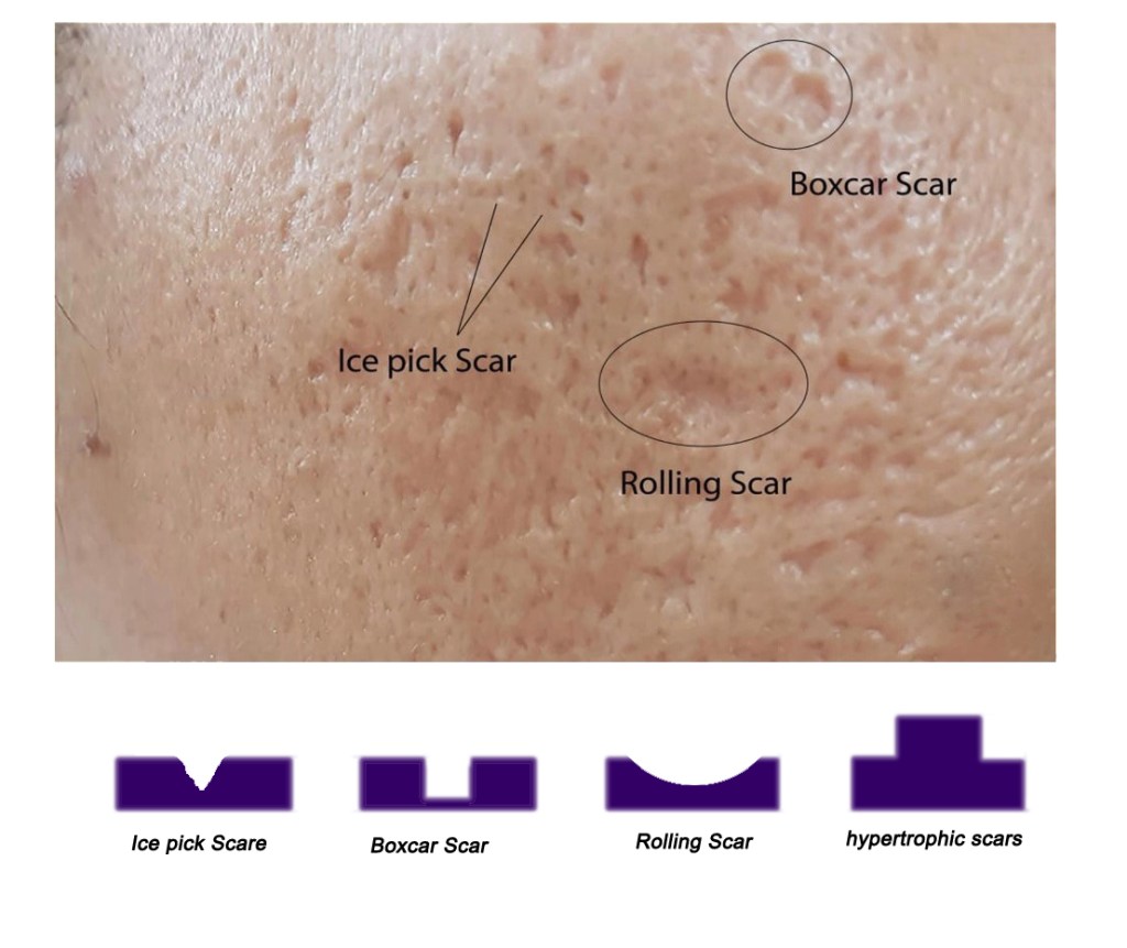 אזור עור עם שלוש סוגי צלקות אקנה: צלקת 'Ice pick' עמוקה, צלקת 'Boxcar' שטוחה וצלקת 'Rolling' רחבה. למטה משורטטים הסברים על סוגי הצלקות.