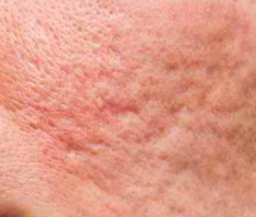Close-up of skin showing acne scars and pockmarks, indicating texture changes and discoloration.