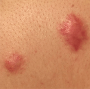 תמונה של צלקות אקנה מוגבהות על עור בגוון בהיר, עם גוון אדמדם בשטחי הצלקות.