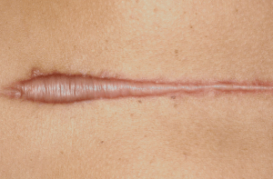 תמונה של צלקת שטוחה וגדולה על גבי עור, המתאפיינת בשוליים ברורים ובמרקם מחוספס.