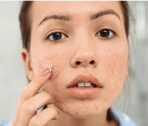 אישה עם עור אקנתי מורחת קרם על פניה, מתמקדת באזור בעייתי.