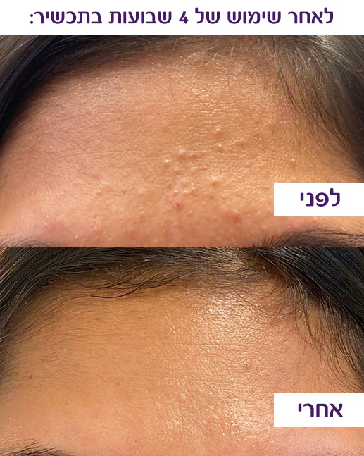תמונה המראה את השיפור בעור הפנים לאחר שימוש של ארבע שבועות במוצר טיפולי: החלק העליון מציג את המצב לפני הטיפול עם פצעים ונקבוביות מורחבות, והחלק התחתון מציג את המצב לאחר הטיפול עם עור חלק וזוהר.