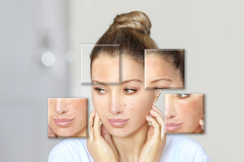 אישה צעירה עם עור פנים, מציגה סימני אקנה וכתמים, עם תמונות מוקטנות של פניה משני הצדדים.