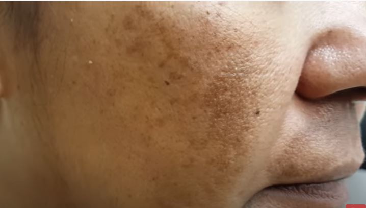 תמונה שמראה כתמים כהים בפנים, המעידים על מלזמה, הנמצאים בעיקר על הלחיים והסנטר.