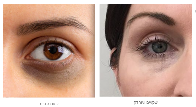 תמונה של עיניים עם כהויות מתחת לכל אחת, מימין עין עם שקעים ועור דק, ומשמאל עין עם כתמים כהים יותר.