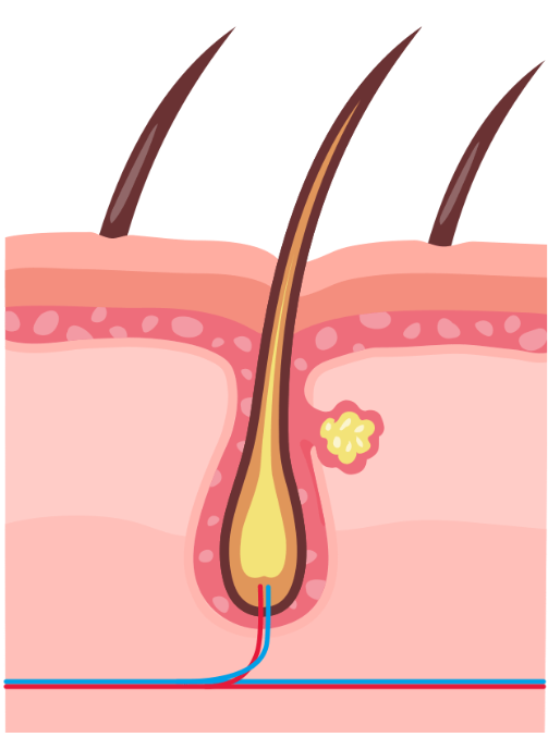 איור של מבנה עור עם זקיקי שיער ובלוטת שומן, שמדגים את מבנה הנקבוביות והשפעתן על העור.