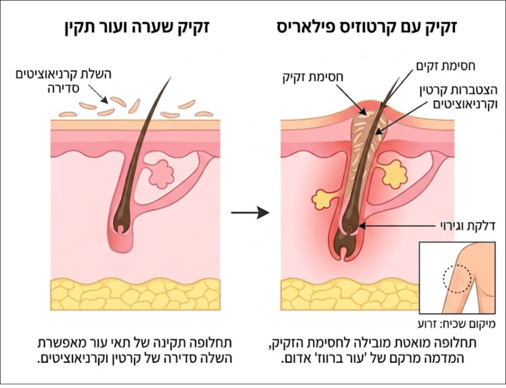 דיאגרמה של זקיק שיער ופעולת חיתוך עם קרטין פילה, מציגה את המבנה הפנימי של זקיק השיער ואת השפעת הקרטין על התהליך.